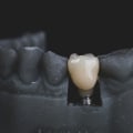 The Pros and Cons of Metal-free Ceramic Dental Implants