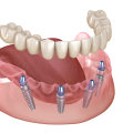 All-on-4 Implants: The Ultimate Solution for Missing Teeth