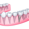 Understanding the Recovery and Healing Process for Dental Implants
