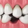 Preventing Implant Failure: Options and Solutions for Replacing Missing Teeth