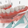 Procedure and Benefits of Modern Implants Compared to Traditional Implants