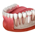 All About Metal-Free Ceramic Implants: A Comprehensive Guide