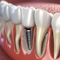 The Cost of Dental Implants in Asia