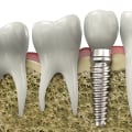 A Comprehensive Look at Dental Implant Suitability for Different Cases