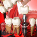 Exploring the Different Types of Dental Implant Materials