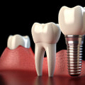 Understanding the Long-Term Success Rates of Dental Implants