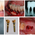 Causes of Implant Failure: Understanding the Risks