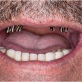 Pros and Cons of Dental Implants Compared to Other Options