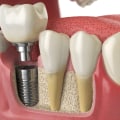Attaching the Abutment to the Implant: A Comprehensive Guide