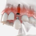 Dealing with Implant Failure: A Step-by-Step Guide