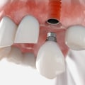 Placing the Final Crown on the Abutment: A Comprehensive Guide for Dental Implant Patients