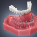 Exploring the Benefits of Mini Dental Implants