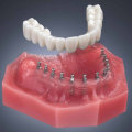 The Benefits and Options of Mini Dental Implants for Replacing Missing Teeth