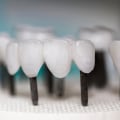Potential Drawbacks of Zirconia Implants: What You Need to Know