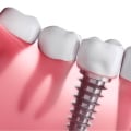 The Cost of Dental Implants in the US: What You Need to Know