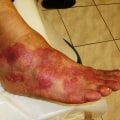 Causes and Symptoms of Infection or Inflammation