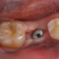 Surgical Procedure for Implant Placement: Everything You Need to Know