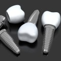 Understanding the Pros and Cons of Traditional Implants: A Comprehensive Guide to Alternative Options