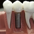 Preventing Infections After Implant Surgery: Everything You Need to Know