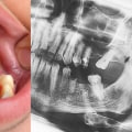 Cost of Implants in Europe: A Comprehensive Guide to Replacing Missing Teeth