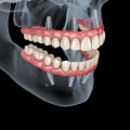 Creating a Treatment Plan for Dental Implants