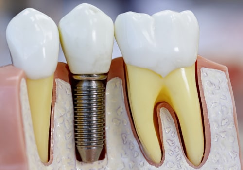 Why Titanium is the Ideal Choice for Dental Implants