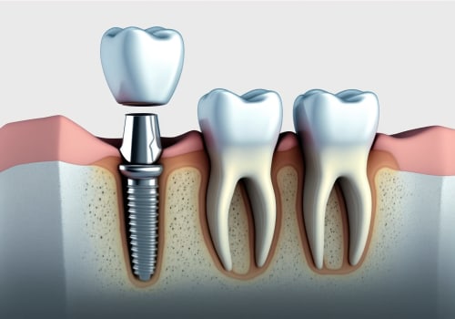 The Complete Guide to Placing Endosteal Implants: A Comprehensive Overview