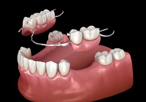 A Comprehensive Look into Types of Removable Dentures