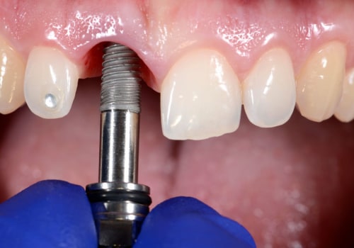 Treatment Options for Infections with Dental Implants