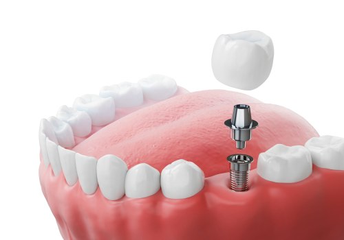 The Benefits of Zirconia Implants: A Comprehensive Guide to Replacing Missing Teeth