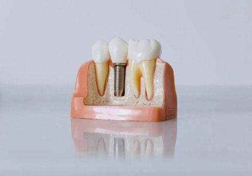 Insurance Coverage for Dental Implants: What You Need to Know