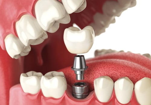 Understanding Dental Implants for Patients with Metal Allergies
