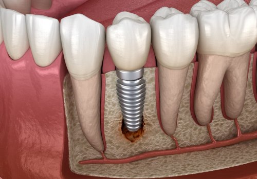 Possible Complications with Dental Implants