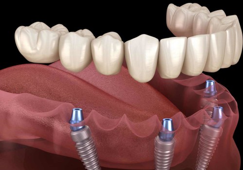 Exploring Additional Procedures and Treatments for Replacing Missing Teeth