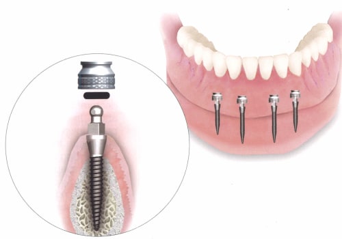 The Procedure for Placing Mini Dental Implants: A Comprehensive Guide