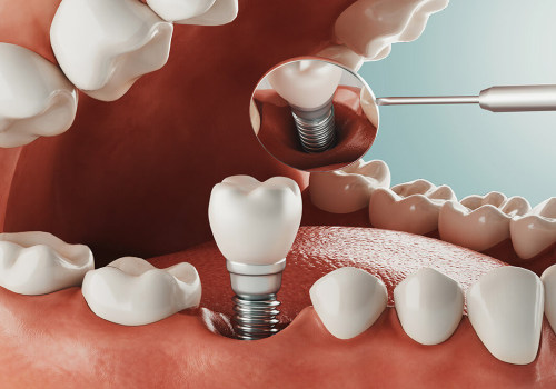 Exploring Alternative Options for Dental Implants