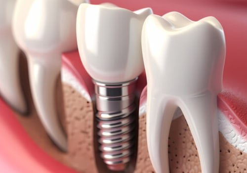 The Complete Guide to Understanding the Number of Implants Needed for Dental Procedures