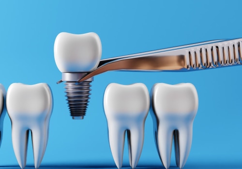 The Hidden Dangers of Nerve Damage from Dental Implants