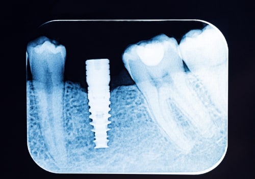 Understanding X-rays and CT Scans for Dental Implant Planning