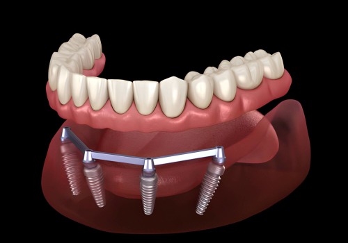 Cost and Financing Options for Dental Implants