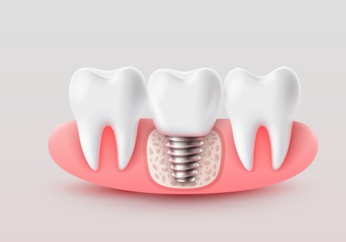 The Benefits of Subperiosteal Implants for Replacing Missing Teeth