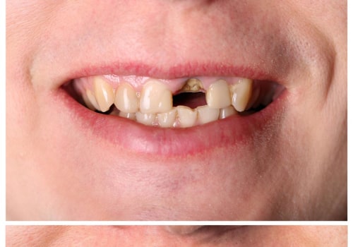 Payment Plans and Financing Options for Dental Implants