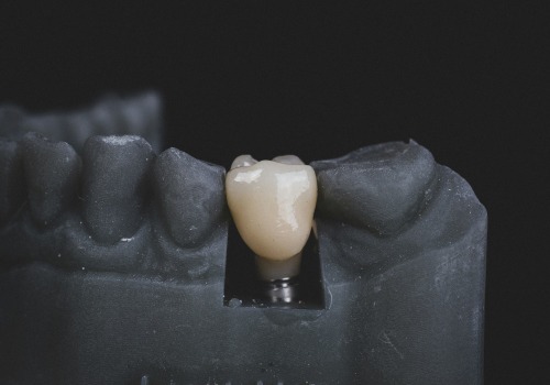 The Pros and Cons of Metal-free Ceramic Dental Implants