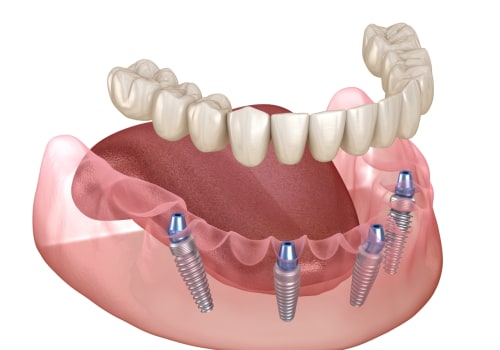 All-on-4 Implants: The Ultimate Solution for Missing Teeth