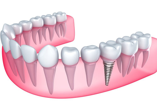 Understanding the Recovery and Healing Process for Dental Implants