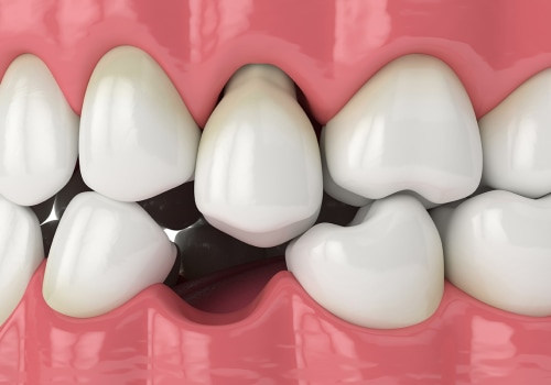Preventing Implant Failure: Options and Solutions for Replacing Missing Teeth