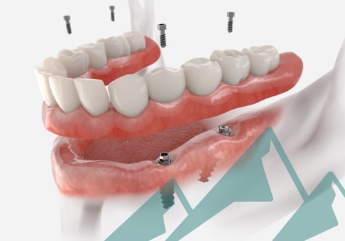 Procedure and Benefits of Modern Implants Compared to Traditional Implants