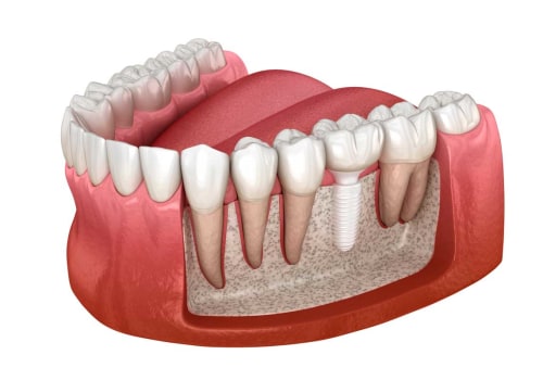 All About Metal-Free Ceramic Implants: A Comprehensive Guide