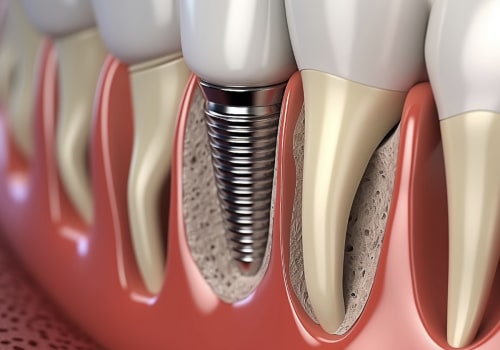 The Cost of Dental Implants in Asia