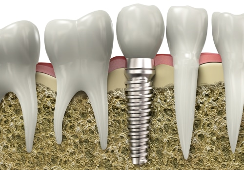 A Comprehensive Look at Dental Implant Suitability for Different Cases